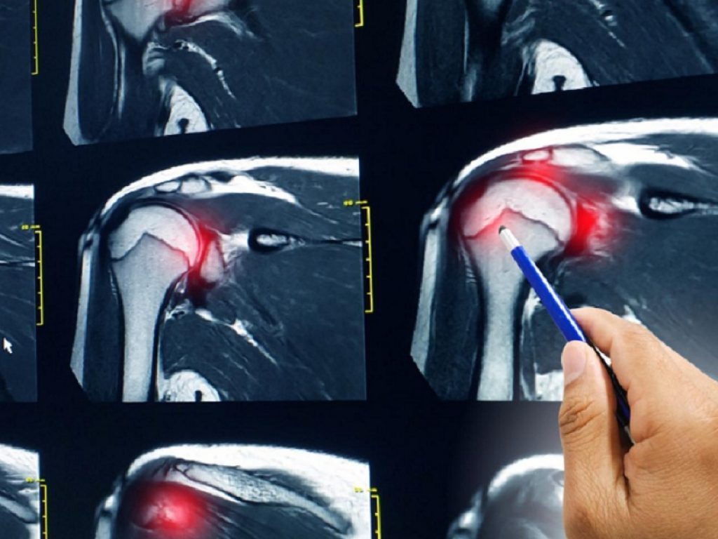 Antidolorifici efficaci dopo riparazione artroscopica della cuffia dei rotatori