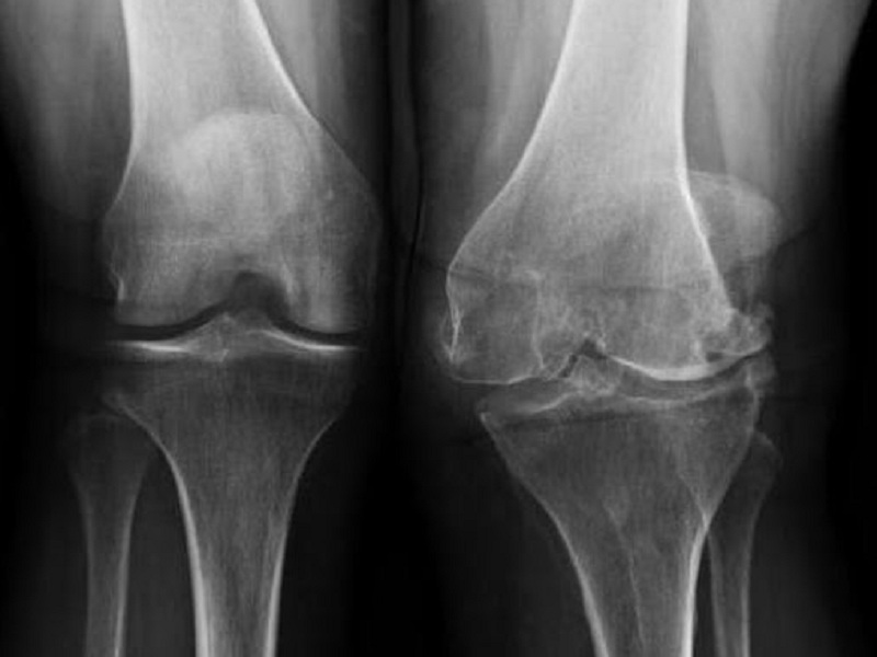 Un incremento dell'assunzione di vitamina K con la dieta si associa a miglioramenti di entità maggiore nei pazienti affetti da gonartrosi
