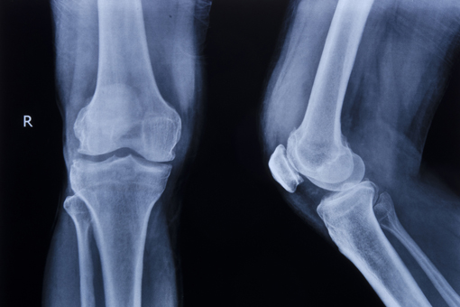Gonartrosi, bisfosfonati efficaci per ridurre la malattia