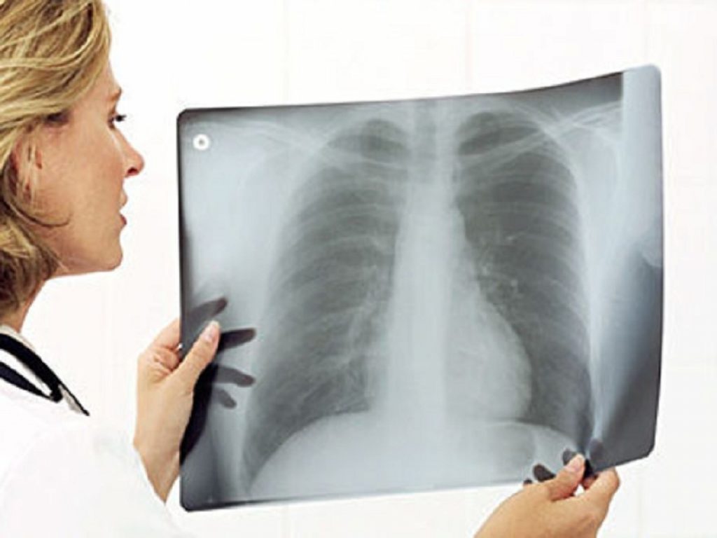 Polmoniti comunitarie: nuovi studi hanno documentato l'efficacia e la sicurezza del trattamento con lefamulina rispetto a moxifloxacina