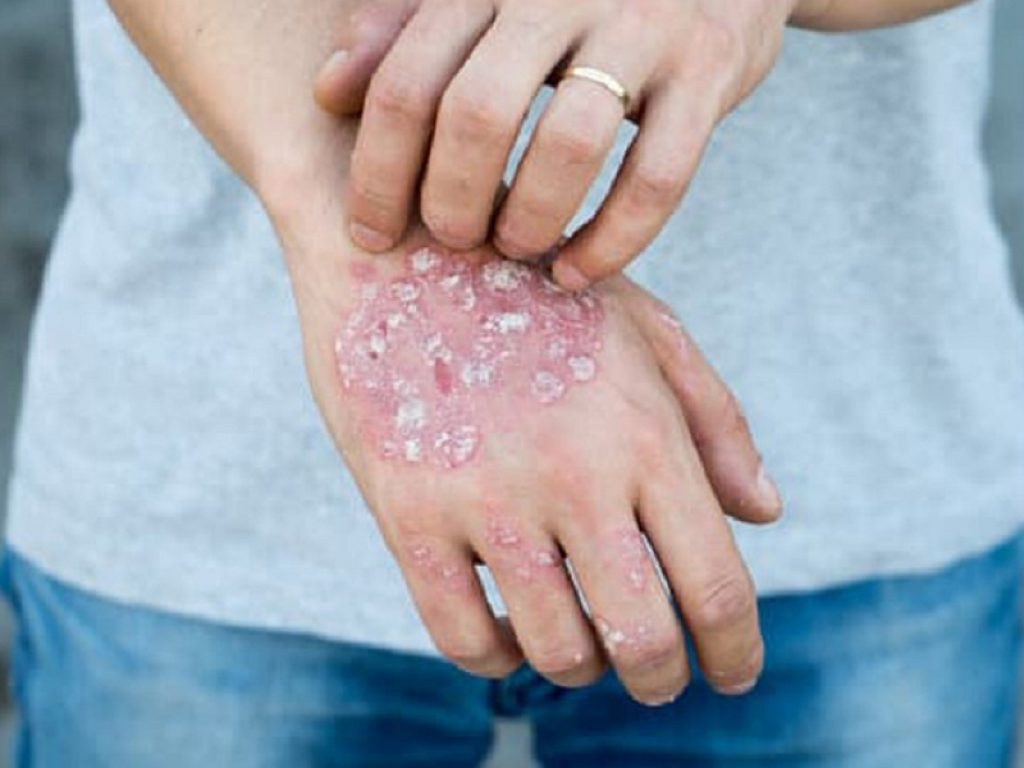 Epidermolisi bollosa: dalla corteccia di betulla un potenziale farmaco per le ferite secondo lo studio di Fase III “EASE”