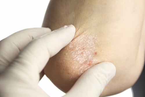 Artrite psoriasica: Aifa ha approvato la rimborsabilità in Italia di Rinvoq (upadacitinib, 15 mg), il primo inibitore orale selettivo e reversibile di JAK