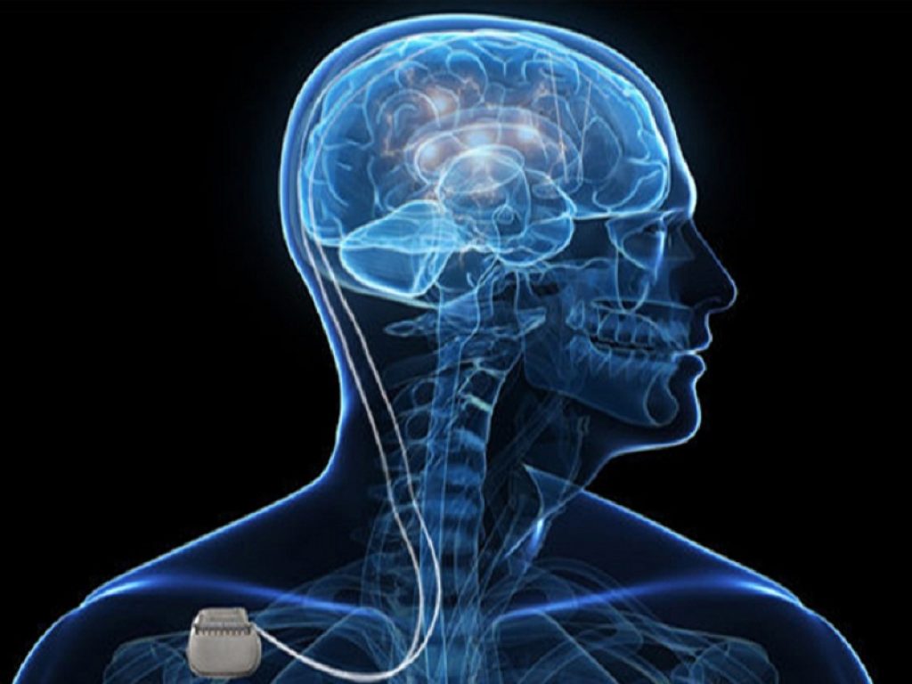 Malattia di Parkinson: la stimolazione cerebrale profonda non aumenta il rischio di demenza secondo un nuovo studio