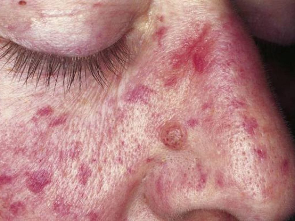 Teleangectasia emorragica ereditaria, bene bevacizumab