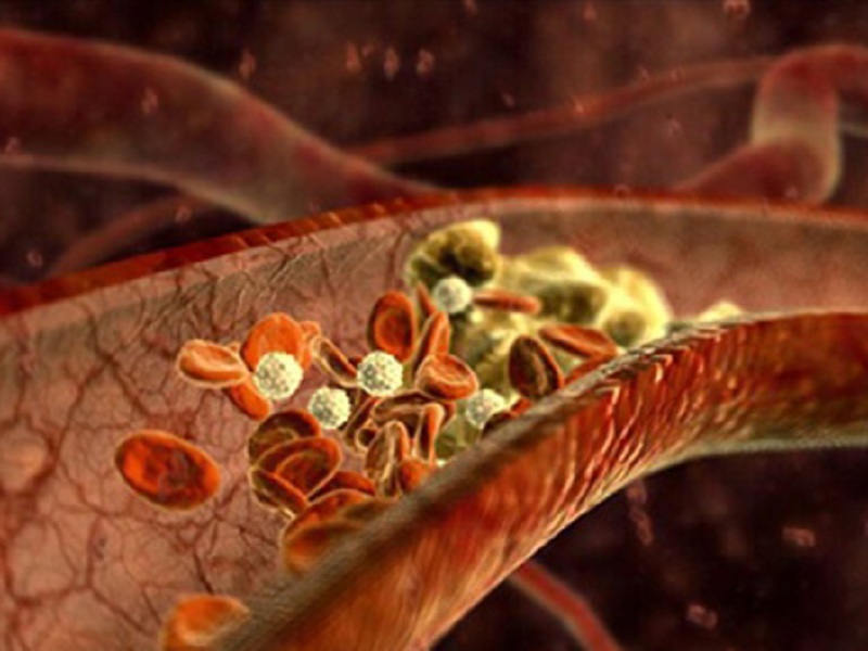 Ogni anno nel mondo si verificano 10 milioni di casi di Trombosi venosa ed Embolia polmonare, che prendono il nome di Tromboembolismo Venoso