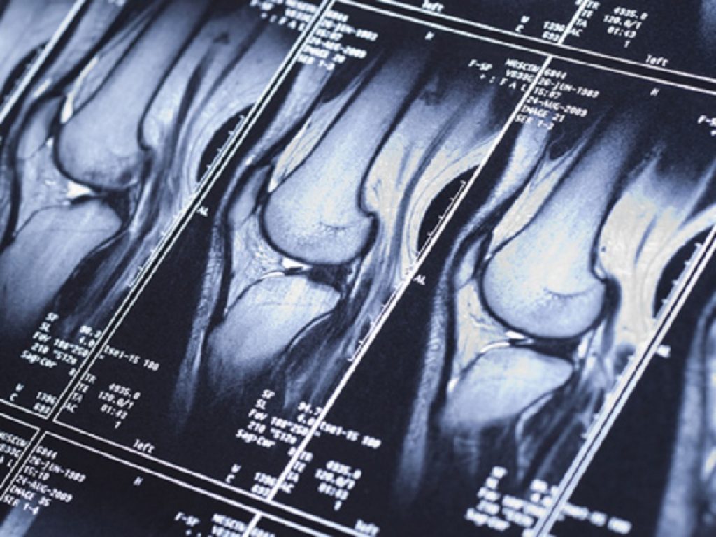 Artroplastica totale all'anca o al ginocchio: aggiornate le linee guida americane sull'impiego di farmaci biologici e immunosoppressori