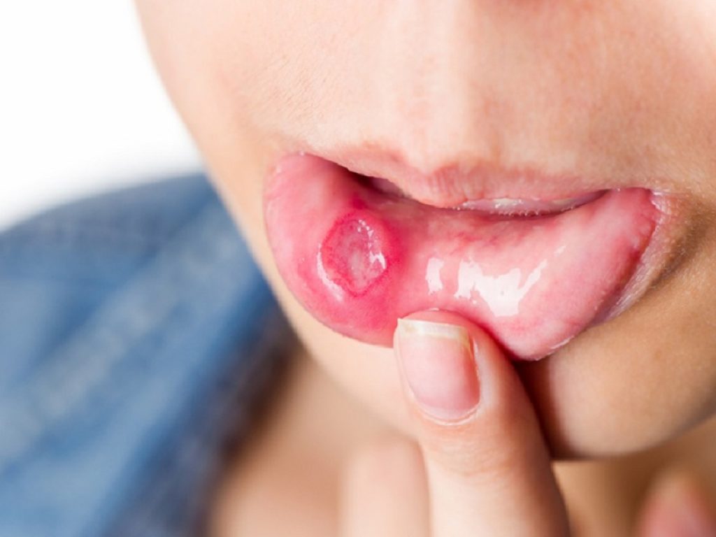 Mucosite orale: sciacqui con blu di metilene efficaci