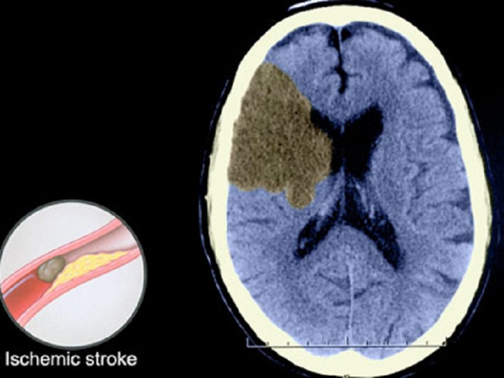 Ictus ischemico da grandi vasi: il trattamento endovascolare può ampliare la finestra terapeutica fino a 10 giorni secondo un nuovo studio