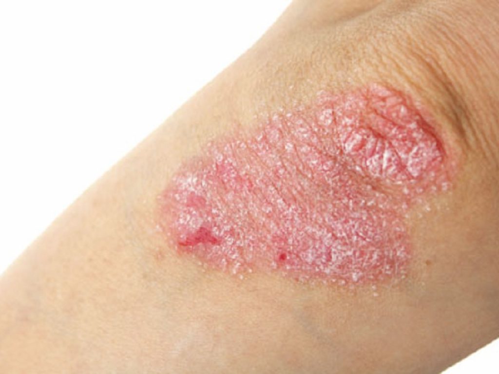 Psoriasi a placche da moderata a grave: i pazienti trattati con tildrakizumab hanno ottenuto un miglioramento significativo della malattia