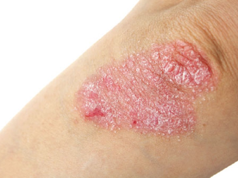 Psoriasi a placche da moderata a grave: i pazienti trattati con tildrakizumab hanno ottenuto un miglioramento significativo della malattia