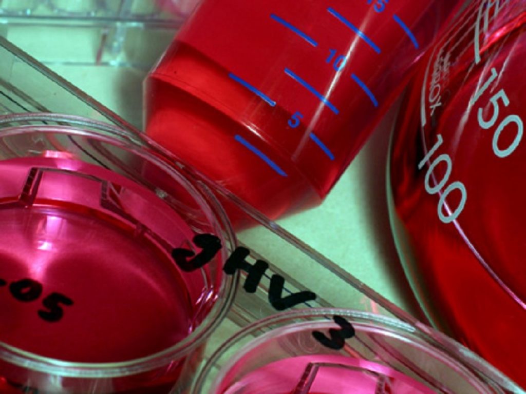 Lo scambio plasmatico con la sostituzione dell'albumina può essere efficace per rallentare i sintomi della malattia di Alzheimer secondo un nuovo studio