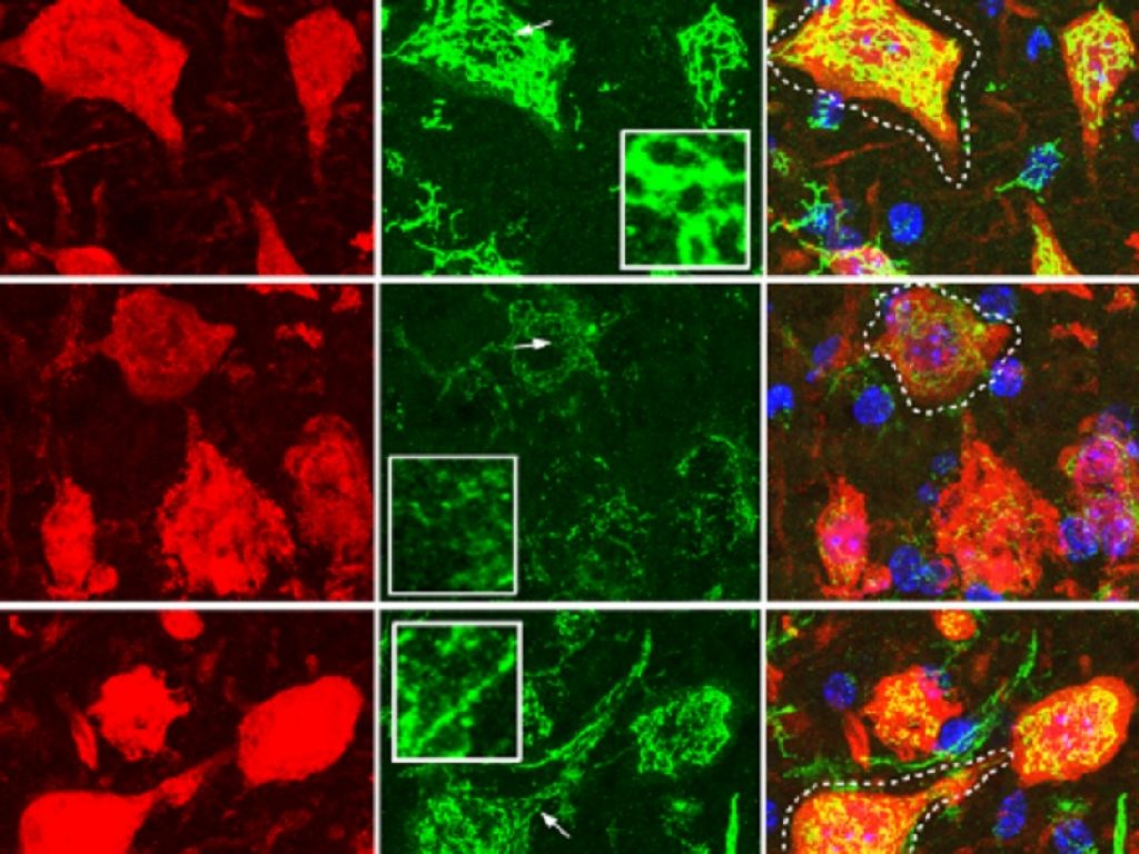 SLA: nuova terapia stabilizza il complesso molecolare