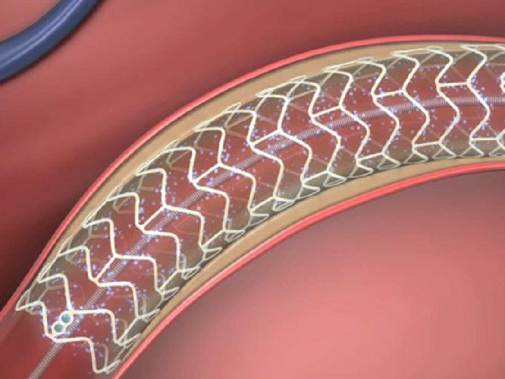 Stent: si rafforza trattamento con doppia terapia