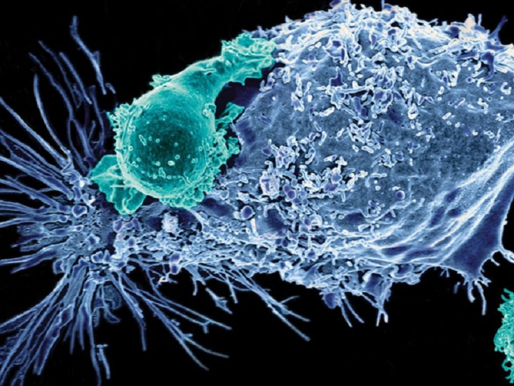 Linfomi a grandi cellule B: le Car-T liso cel efficaci