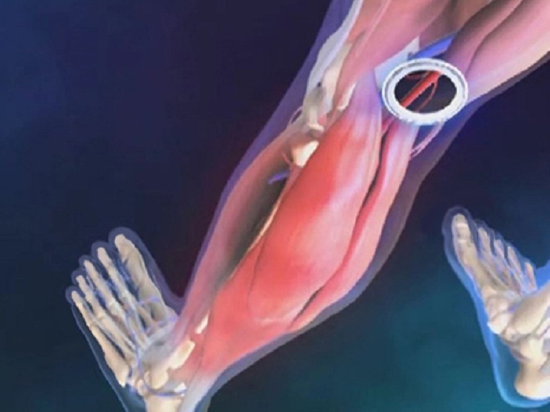 Arteriopatia periferica, conferme per rivaroxaban dallo studio VOYAGER PAD