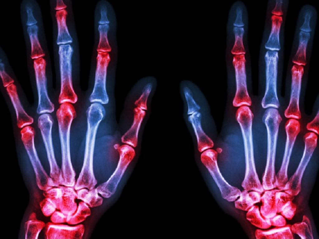 Artrite reumatoide: il trattamento con la terapia di combinazione o con i farmaci biologici abbatte anche il rischio diabetico