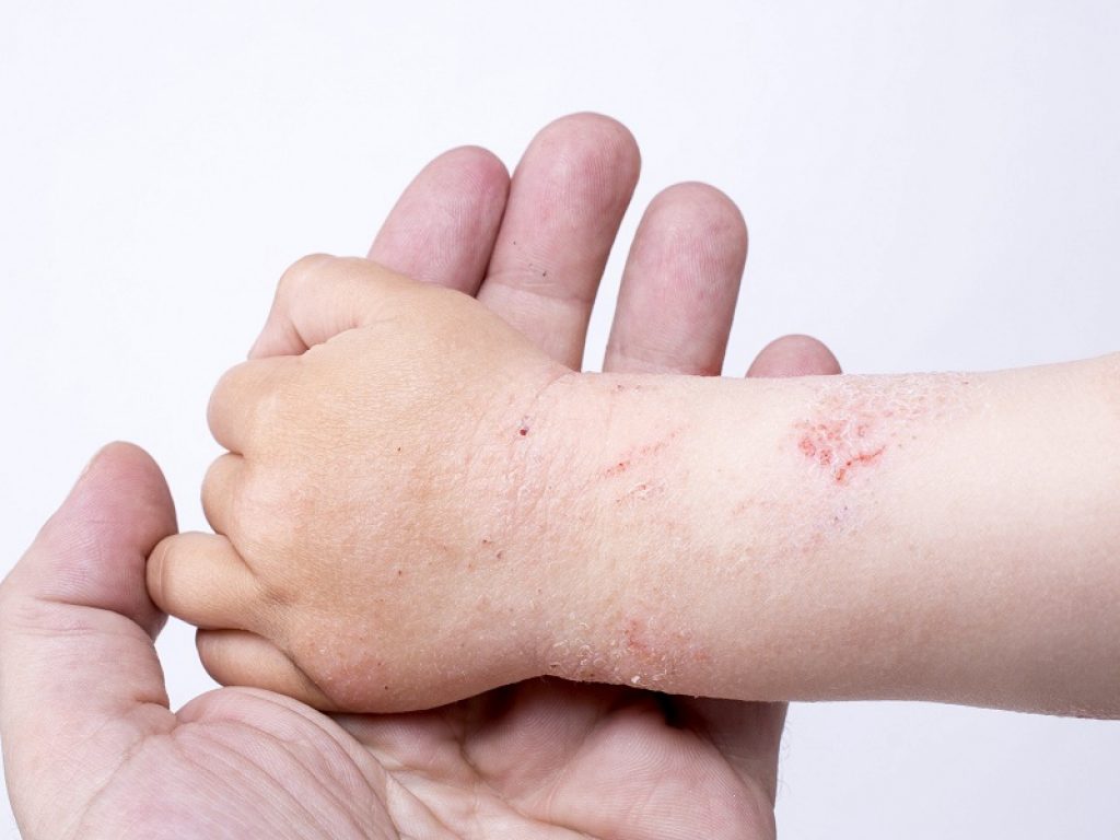 Dermatite atopica: secondo un nuovo studio i bambini si solito provano un prurito più intenso nelle prime ore della sera o prima di coricarsi
