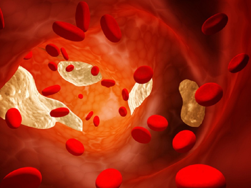 Mortalità da malattia coronarica o arteriosa periferica: confermata la superiorità di rivaroxaban più aspirina rispetto alla sola aspirina
