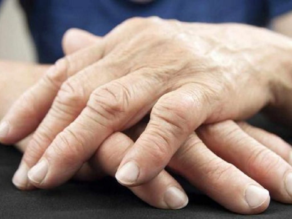 La remissione clinica nell'artrite reumatoide è associata a benefici economici, quali una riduzione fino al 75% dei costi medici legati alla patologia, secondo nuovi studi