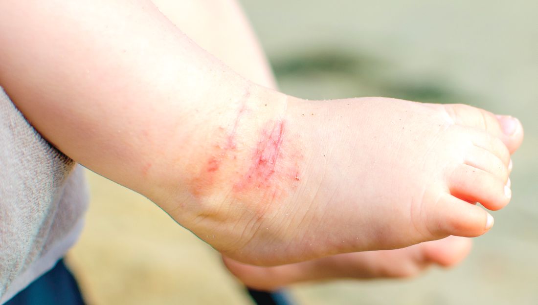 Dermatite atopica da lieve a moderata: l'applicazione una volta al giorno dell'unguento a base di crisaborolo al 2% può essere una terapia di mantenimento a lungo termine