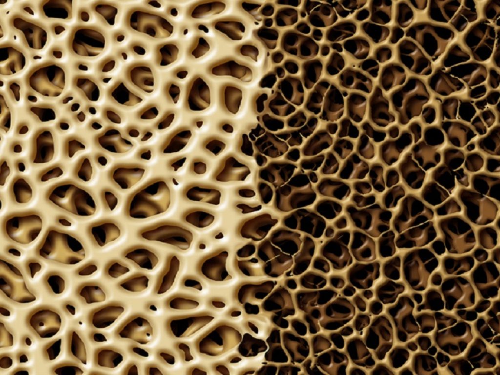 Gli adulti con diabete di tipo 1 da almeno 25 anni hanno una densità minerale ossea (BMD) areale inferiore rispetto a quelli senza diabete