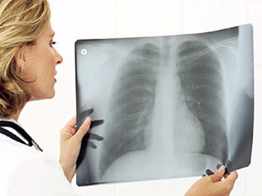 Interstiziopatia polmonare fibrosante associata a patologie autoimmuni: nintedanib rallenta del 60% il tasso di declino della capacità vitale forzata