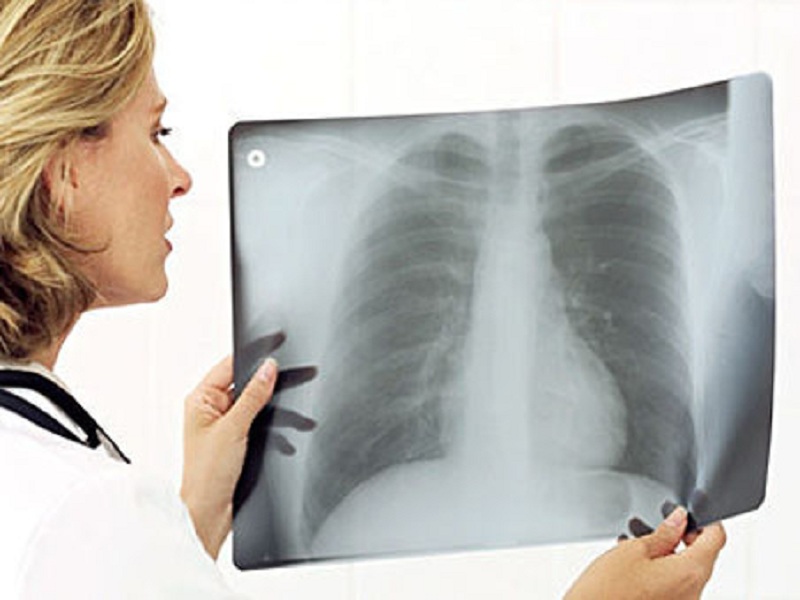 Interstiziopatia polmonare fibrosante associata a patologie autoimmuni: nintedanib rallenta del 60% il tasso di declino della capacità vitale forzata