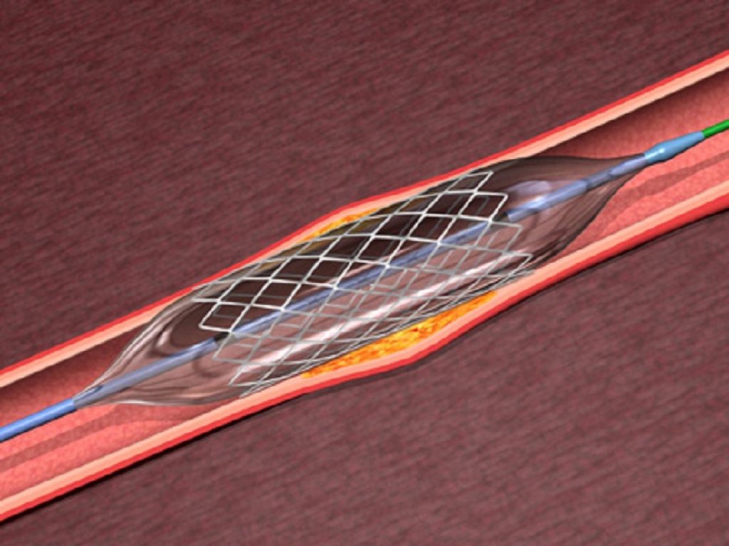 Stenting coronarico: bene prasugrel senza aspirina