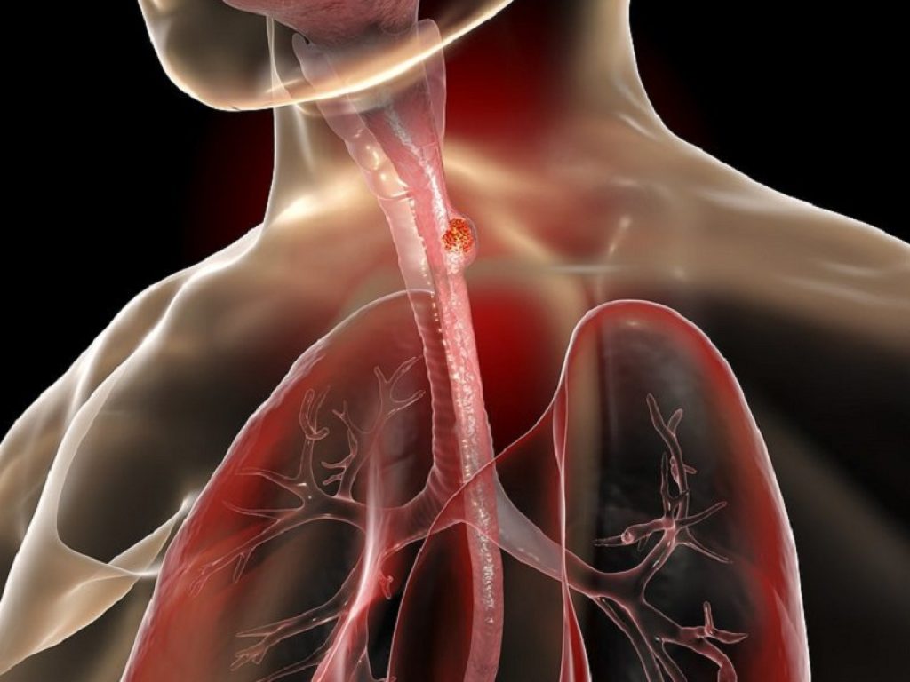 Tumore dell'esofago: per la prima volta passi avanti nella cura della neoplasia. Secondo nuovi dati l'immunoterapia migliora la sopravvivenza