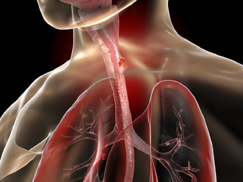 Tumore dell'esofago: per la prima volta passi avanti nella cura della neoplasia. Secondo nuovi dati l'immunoterapia migliora la sopravvivenza