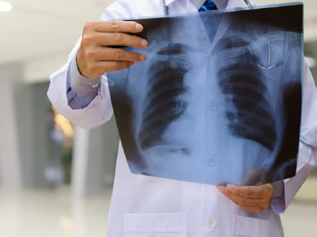 Cancro del polmone: approvazione europea per sotorasib