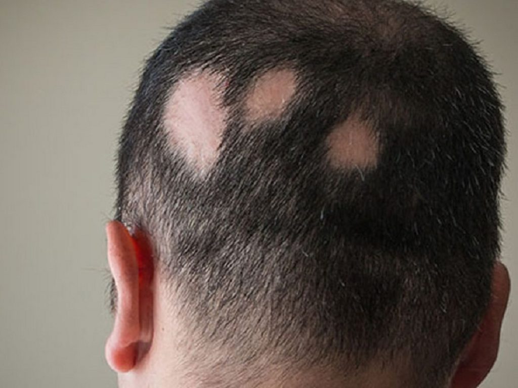 Nuove terapie per l'alopecia cicatriziale centrifuga