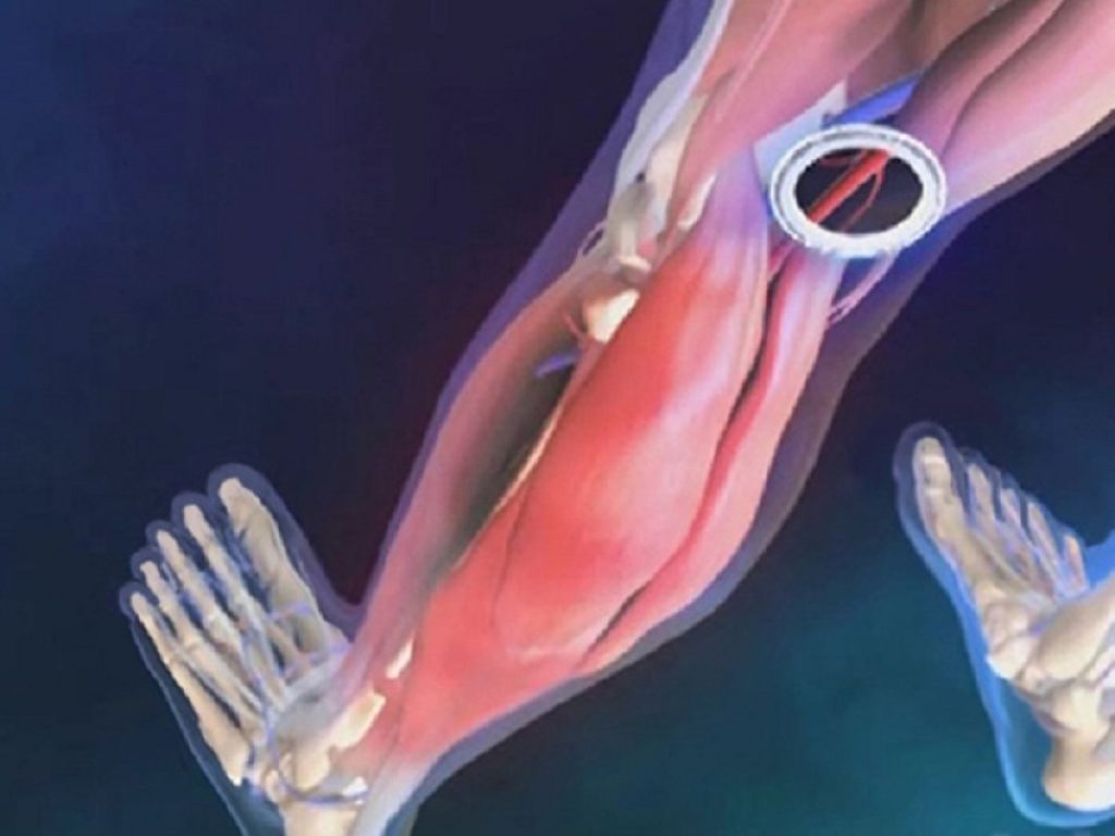 Rivascolarizzazione: più vantaggi da rivaroxaban