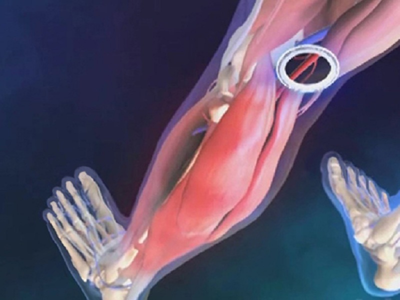 Rivascolarizzazione: più vantaggi da rivaroxaban