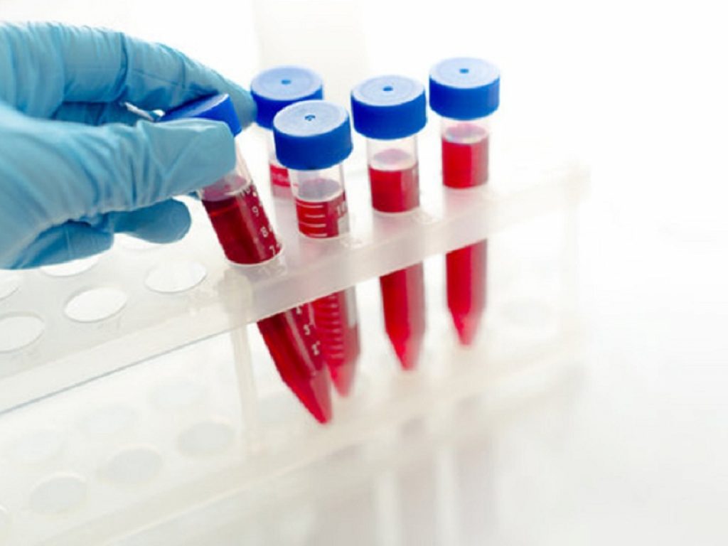 Allelica ha realizzato un semplice test genetico salivare, chiamato CardioriskSCORE, che consente di individuare il rischio di infarto legato al colesterolo cattivo