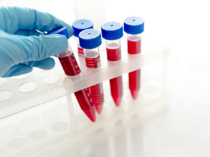 Allelica ha realizzato un semplice test genetico salivare, chiamato CardioriskSCORE, che consente di individuare il rischio di infarto legato al colesterolo cattivo