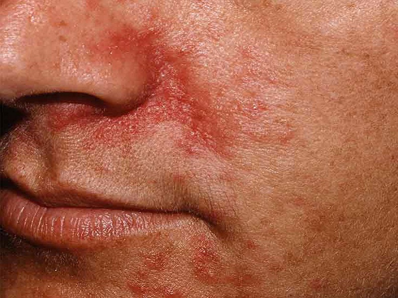 Dermatite seborroica: dati di fase II positivi per la schiuma a base di roflumilast con applicazione giornaliera