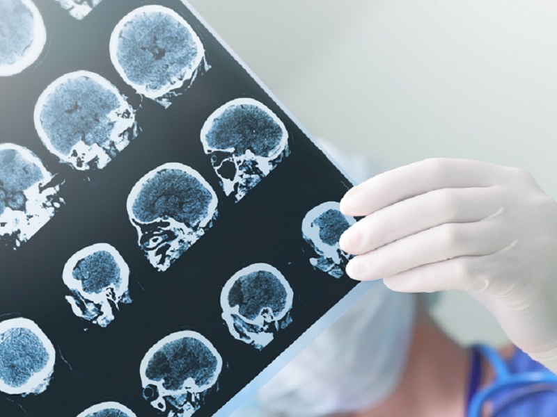 L'efficacia di fenfluramina nella sindrome di Dravet confermata dagli studi di reale pratica clinica (RWE, real world evidence) italiani