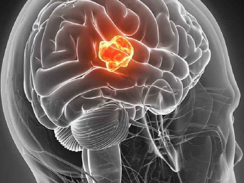 L'Aloe-emodin, un composto derivato dalle foglie di aloe noto per le sue proprietà potenzialmente benefiche, è una nuova arma contro il glioblastoma