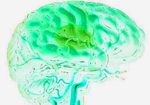 Ictus ischemico acuto: tenecteplase, trombolitico somministrato in bolo alla dose di 0,25 mg/kg, non è risultato inferiore ad alteplase, lo standard di cura