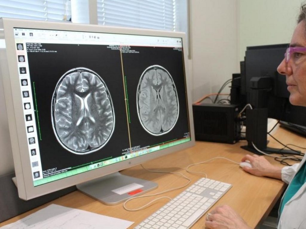 Neuro-COVID: encefaliti e ictus principali manifestazioni