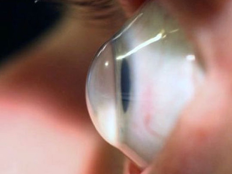 Visione "4K" senza occhiali: le lenti intraoculari sono l’alternativa al laser ma in Italia sono ancora poco conosciute