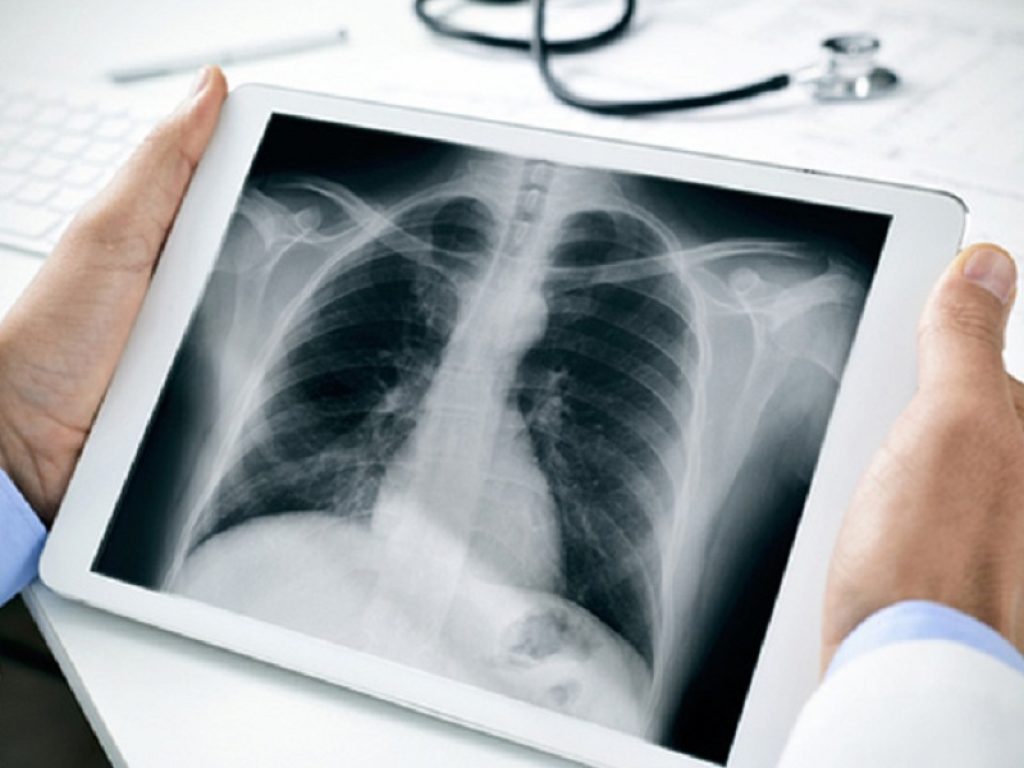 Krebs von den Lungen-6 (KL-6), proteina surfattante D (SP-D), e interleuchina-8 (IL-8): identificati biomarcatori solubili per la diagnosi di SSc-ILD