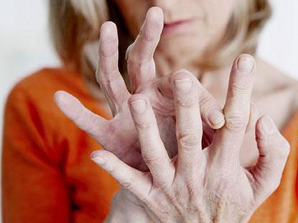 Sclerosi sistemica: per un modello di predizione clinica di EUSTAR, l'impiego di inibitori piastrinici risulta associato ad una minore probabilità di sviluppo di ulcere digitali