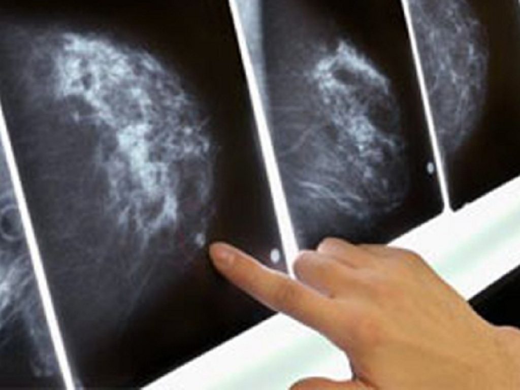 Carcinoma mammario HR+/HER2- in fase avanzata: la combinazione di palbociclib e fulvestrant migliora la sopravvivenza libera da progressione secondo un nuovo studio