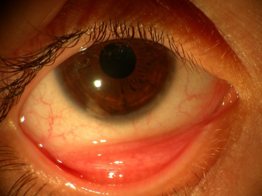 Cos'è la Vernal, la congiuntivite che colpisce soprattutto gli adolescenti maschi: sintomi e cure della malattia infiammatoria cronica degli occhi