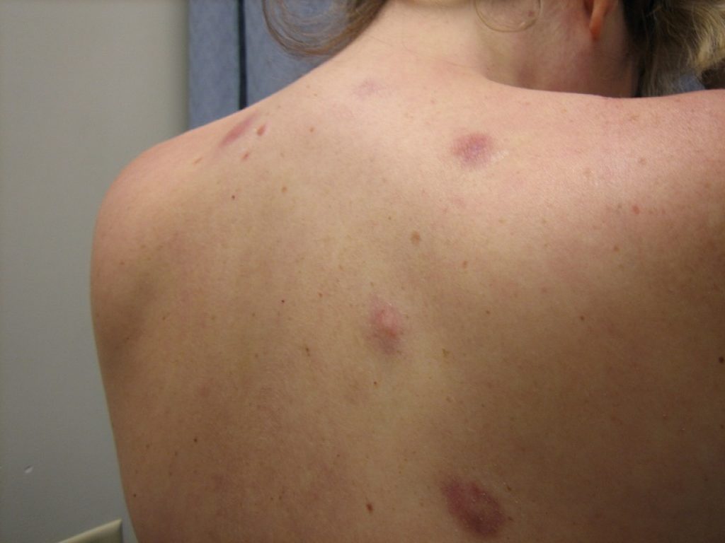 Melanoma: buone risposte con aggiunta tavokinogene