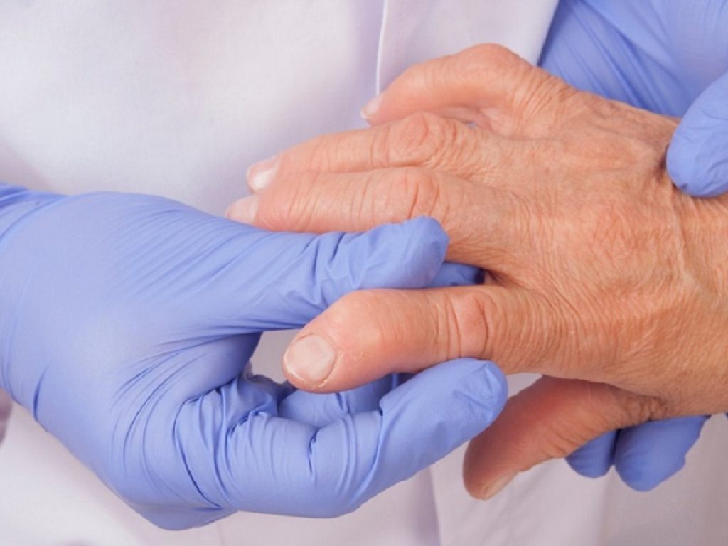 Artrite reumatoide: nuovo studio suggerisce che i livelli di calprotectina sierica potrebbero rappresentare un biomarcatore di infiammazione