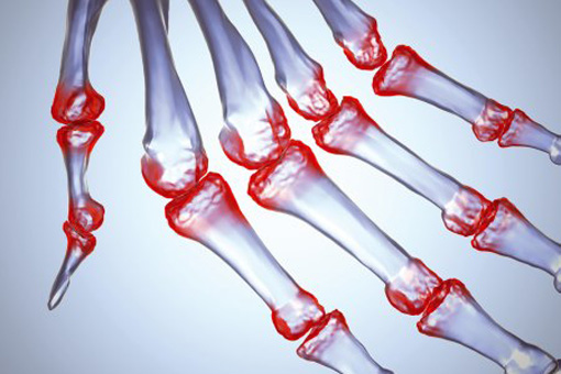 Artrite reumatoide: il BMI non sembra influenzare la scelta di un farmaco anti-TNF rispetto ad un altro farmaco biologico