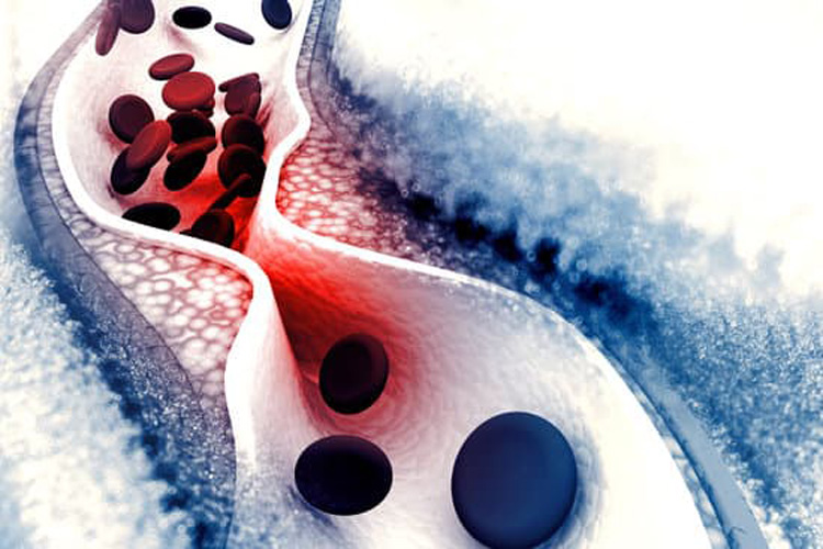 Prevenzione cardiovascolare: alirocumab riduce il colesterolo delle lipoproteine non ad alta densità secondo uno studio pubblicato sull'European Journal of Preventive Cardiology